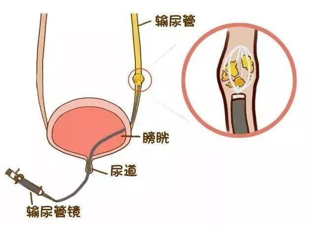 雅安結(jié)石病治療6