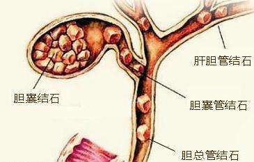 雅安結石病治療9