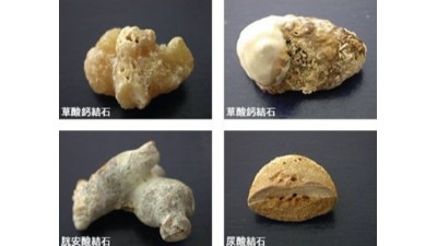 結石治療最佳方案