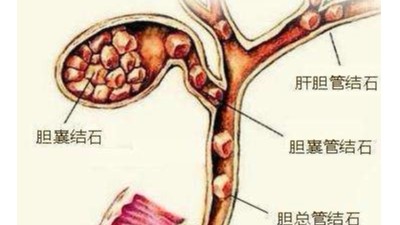 膽囊結(jié)石可以不切膽嗎？